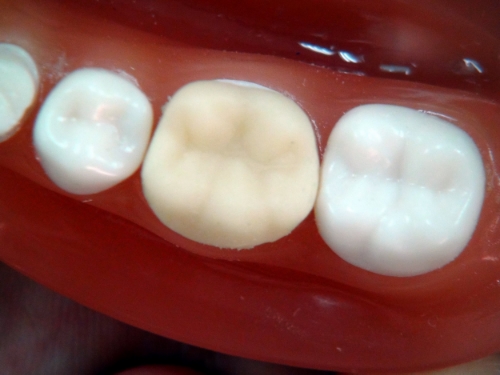 Temporary crowns are not as developed or strong as permanent crowns because they are only intended to function for about two weeks. 