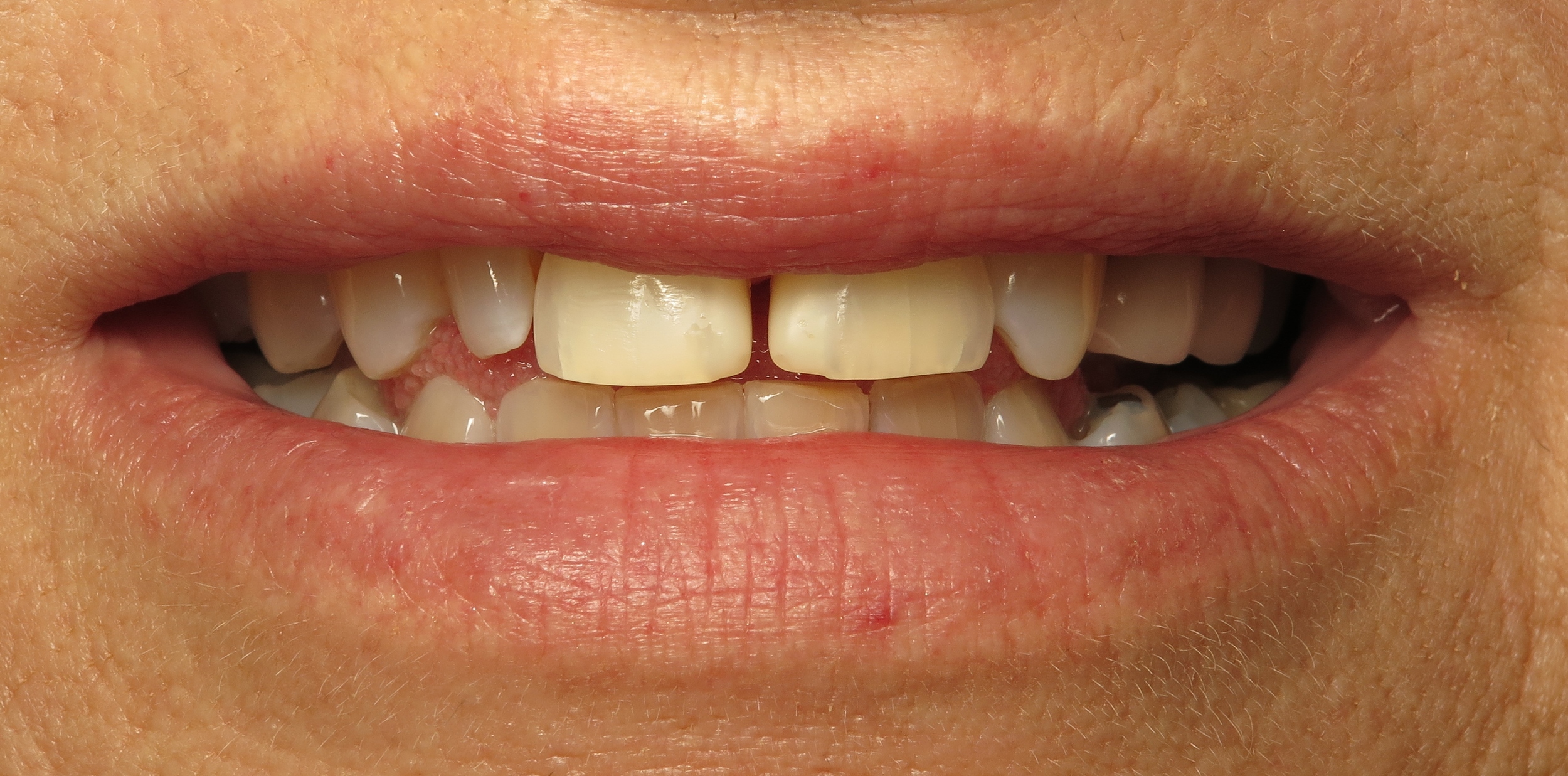 Before veneers, this patient's teeth had large spacings and were not completely symmetrical. 