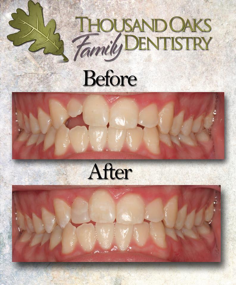 This new tooth was restored using only bonding and disking. What a change!
