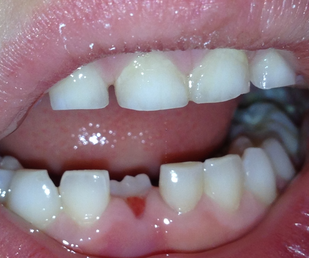 Likewise, the mandibular primary central incisors are the first baby teeth to be lost (notice the permanent tooth erupting it its place). 