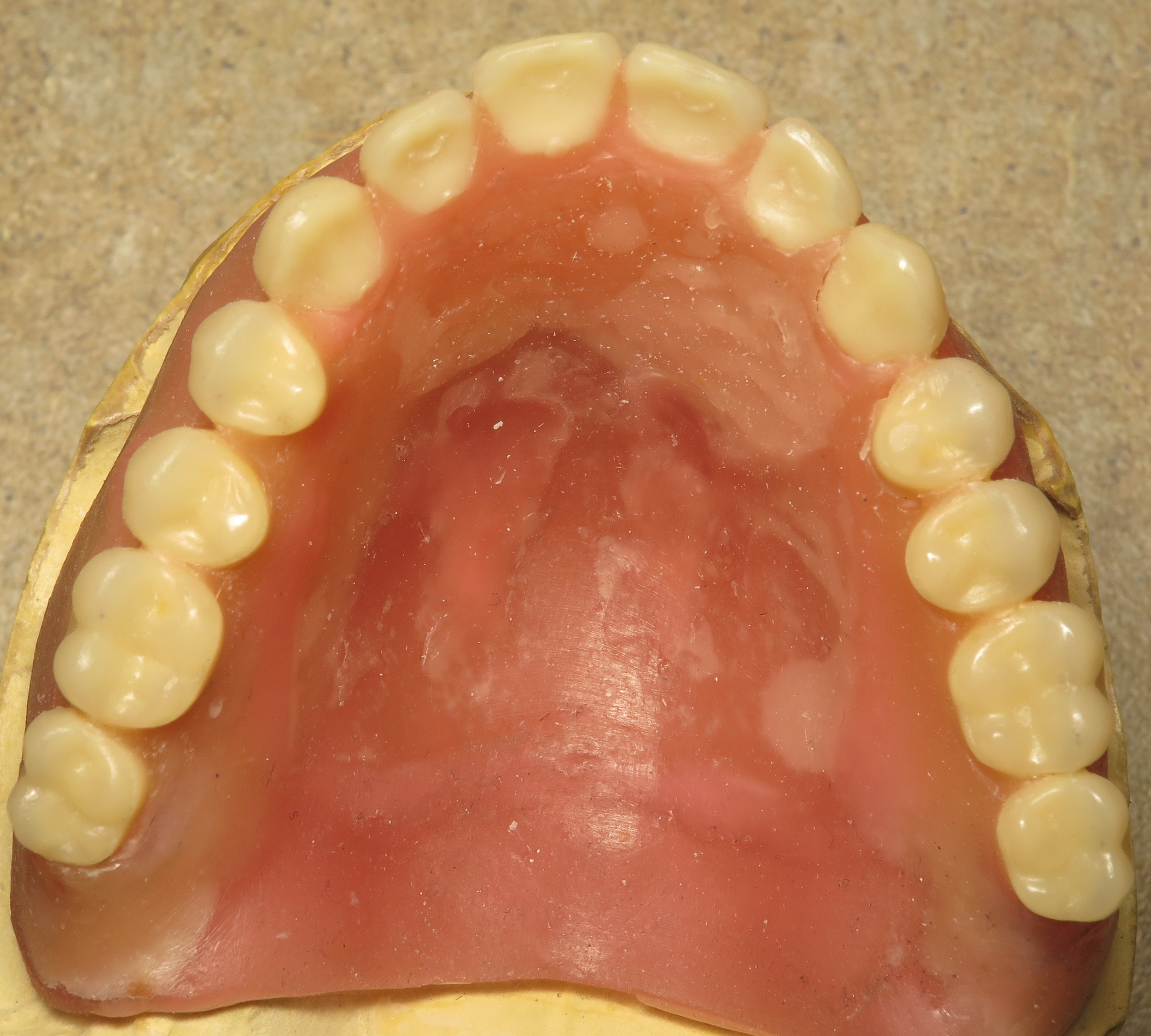 Thousand Oaks Family Dentistry - Denture Occlusal View in Wax.jpg