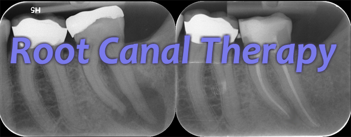 Before and after X-rays of a completed root canal (rightmost tooth). Notice how the roots have whiter centers once the procedure was finished. 