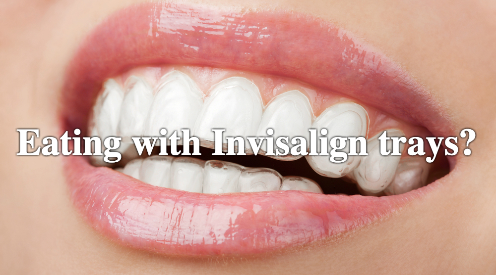 Dental Questions: Can I eat with my Invisalign trays on?