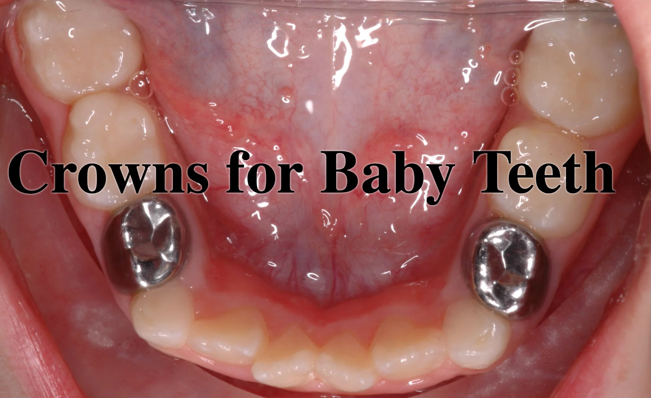 Crowns for Baby Teeth