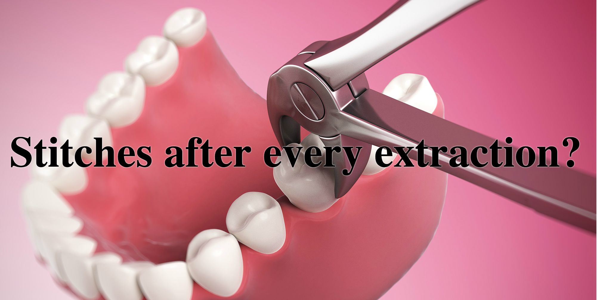 Tooth extraction. Сайт стоматологии.