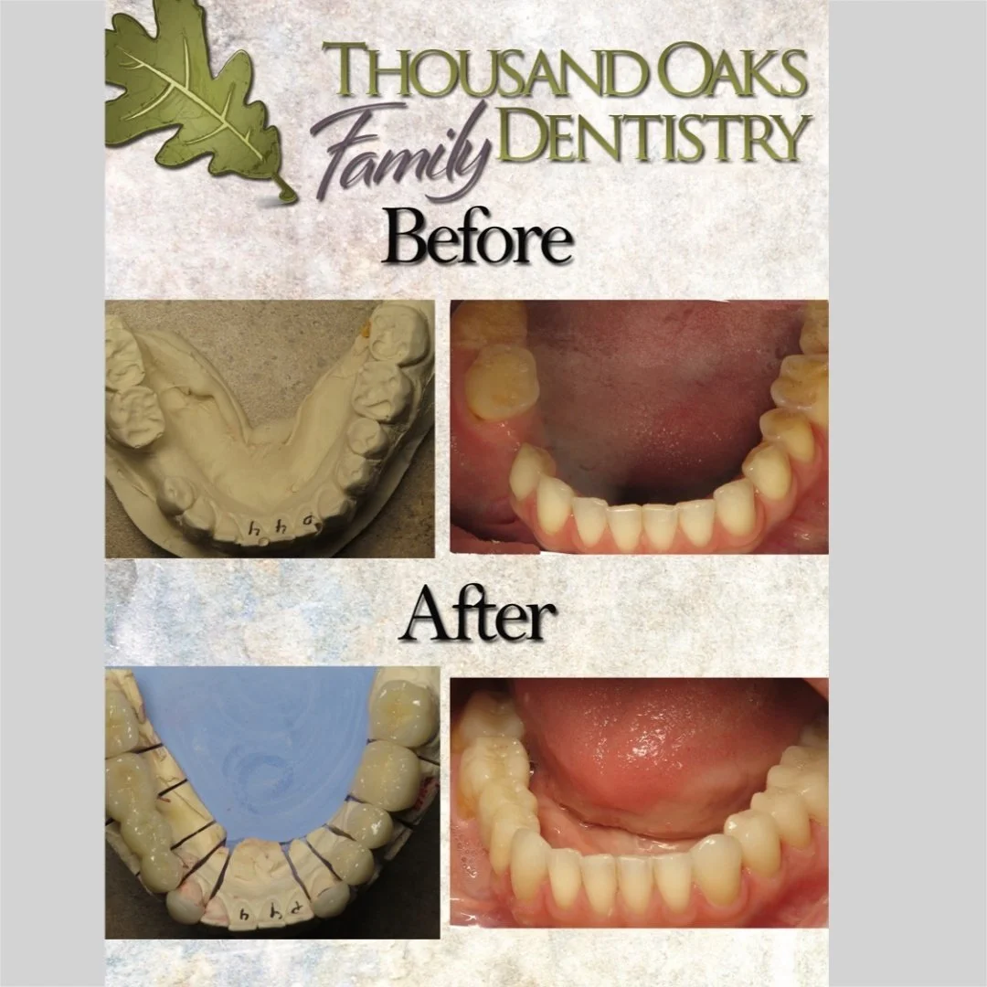 Bridge to replace missing tooth