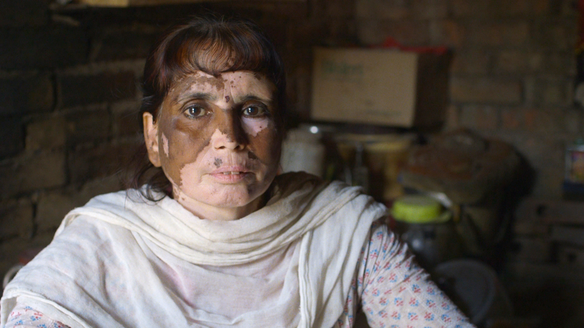 A woman who was born with an alarming skin condition due to contaminated water, food and air in her village that is situated next to a leather tannery. Image Source: The True Cost.
