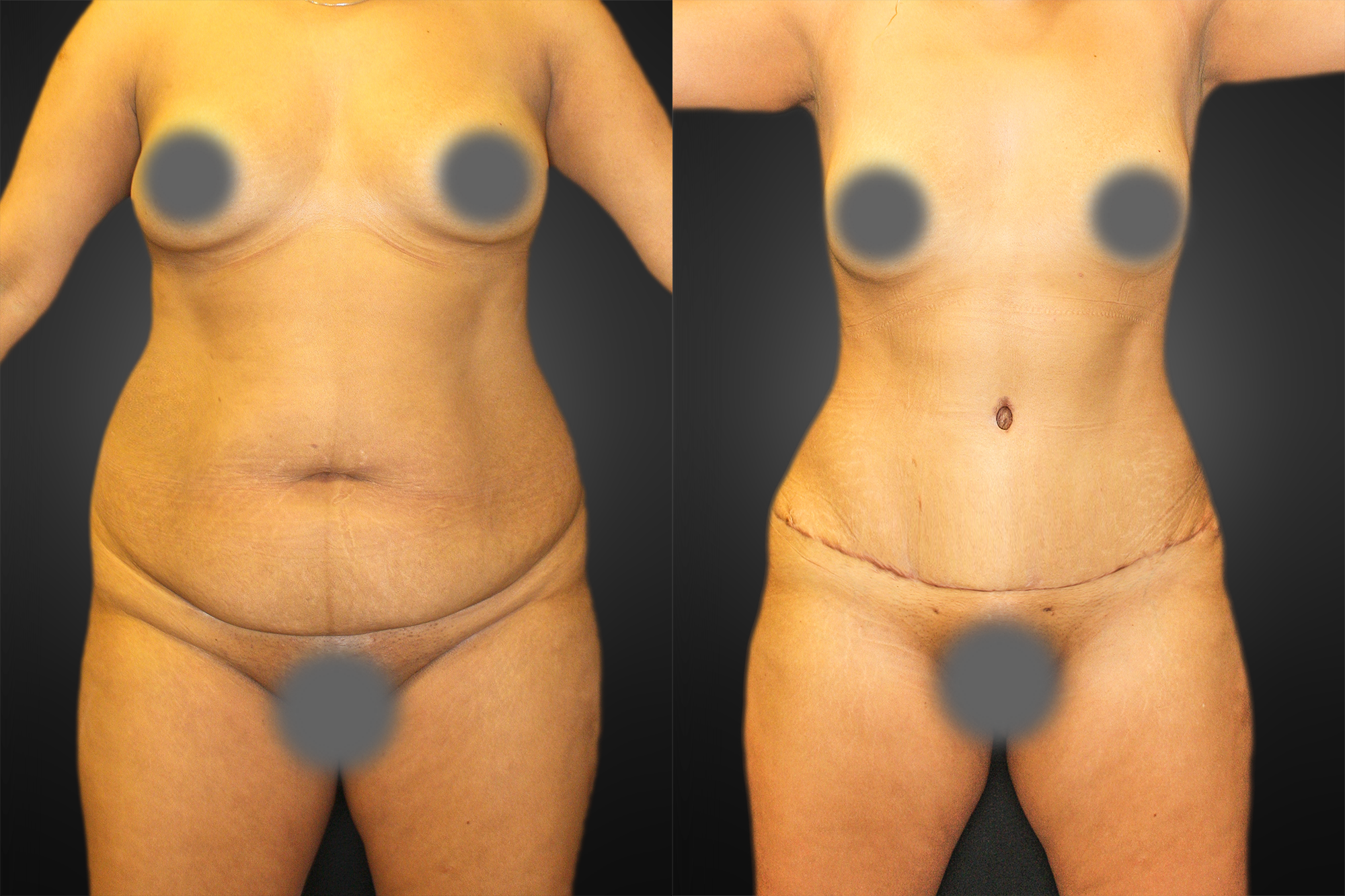 Tummy Tuck