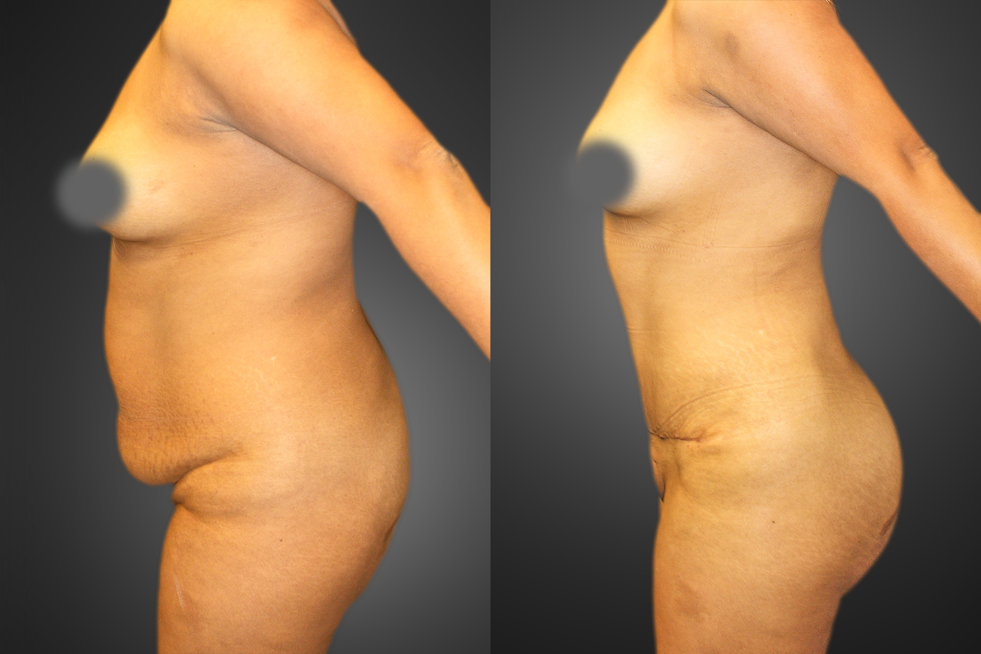 Tummy Tuck