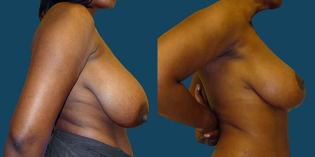 Breast Lift