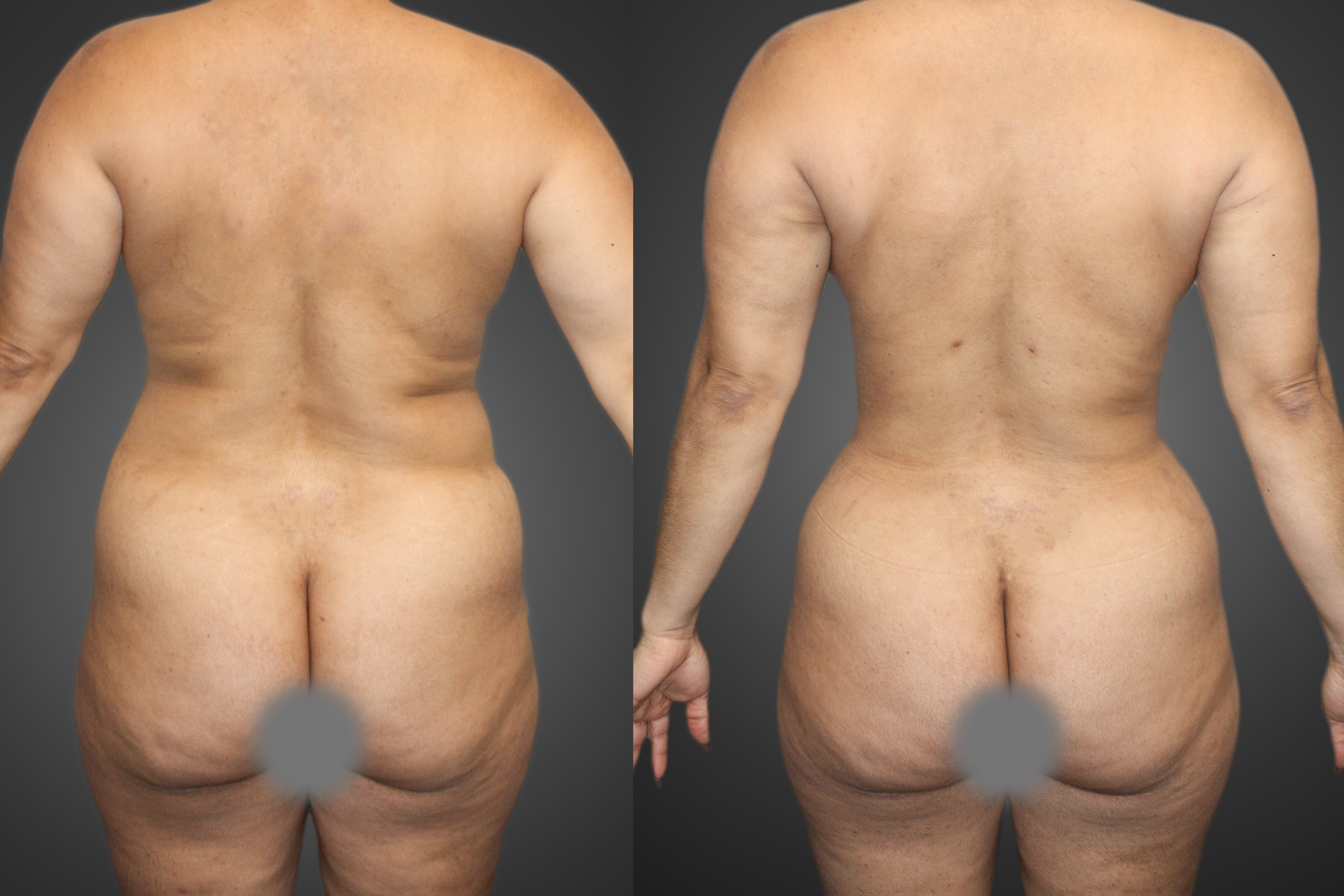 Liposuction