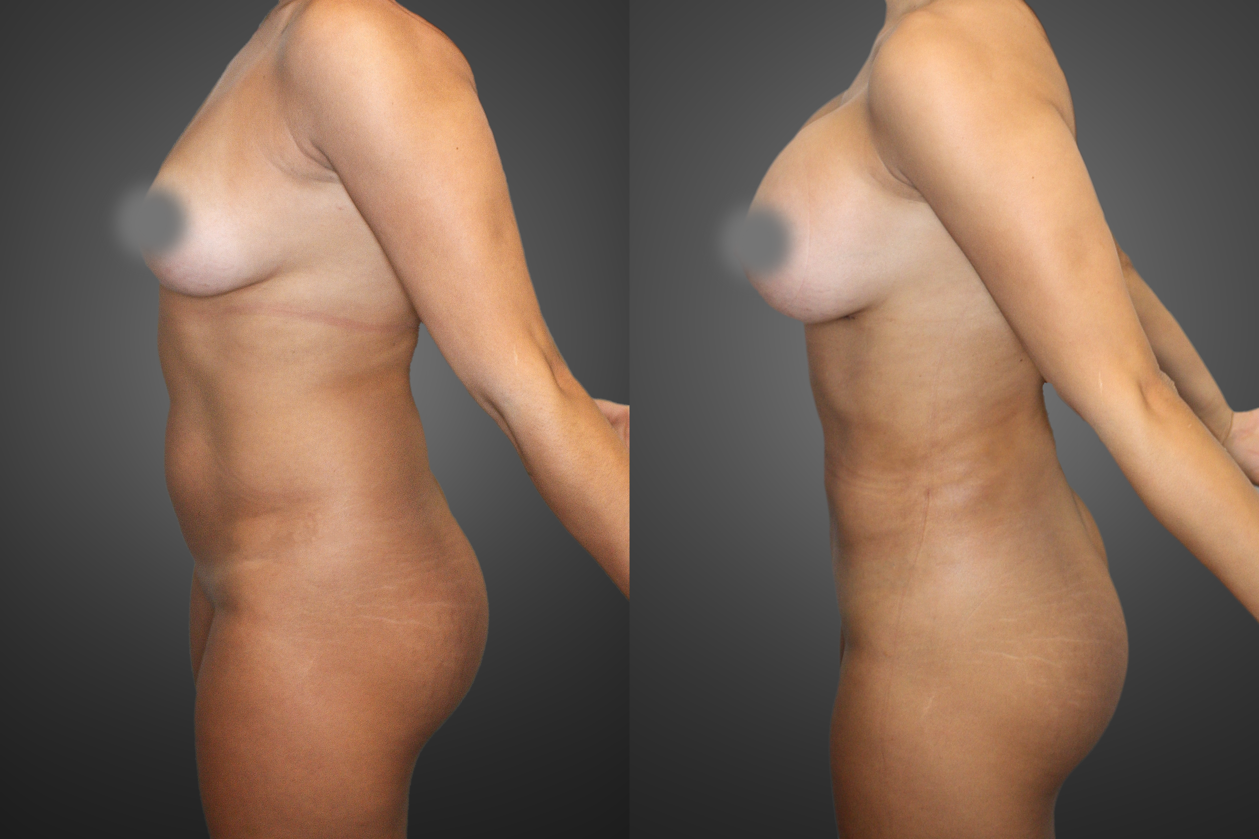 Breast augmentation and Liposuction