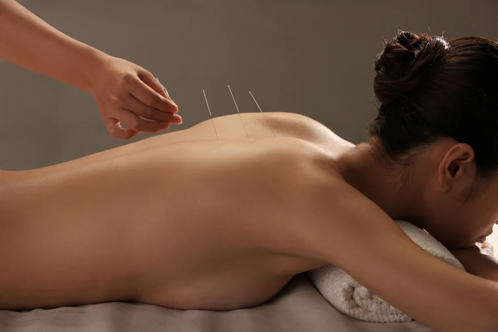 ACUPUNCTURE