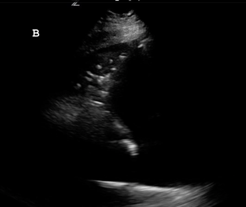 Figure B. L4 view of lung 