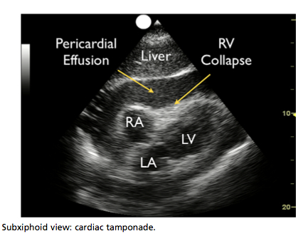 Figure A: "The Pump" - Cardiac Tamponade