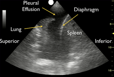 Figure B: "The Tank" - Pleural Effusion