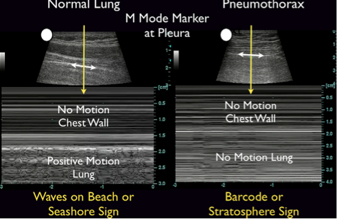 Figure C: "The Tank" - Normal Lung and Pneumothorax
