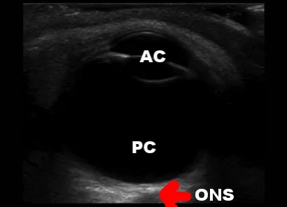 AC: anterior chamber, PC: posterior chamber, ONS: optic nerve sheath