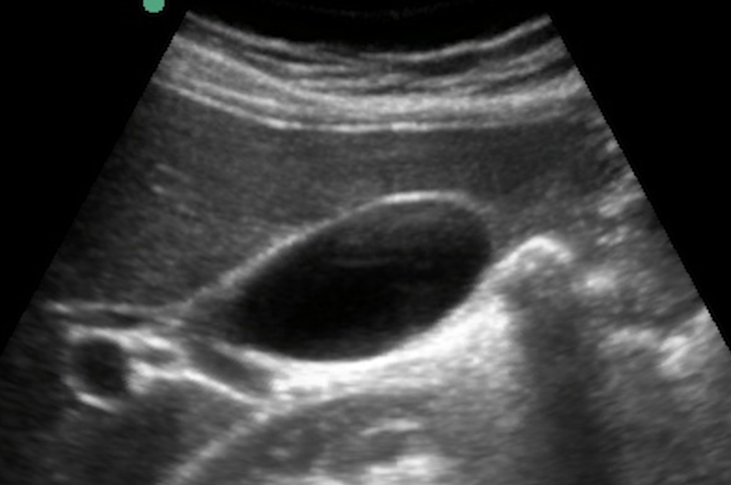 Gallbladder Mass Ultrasound