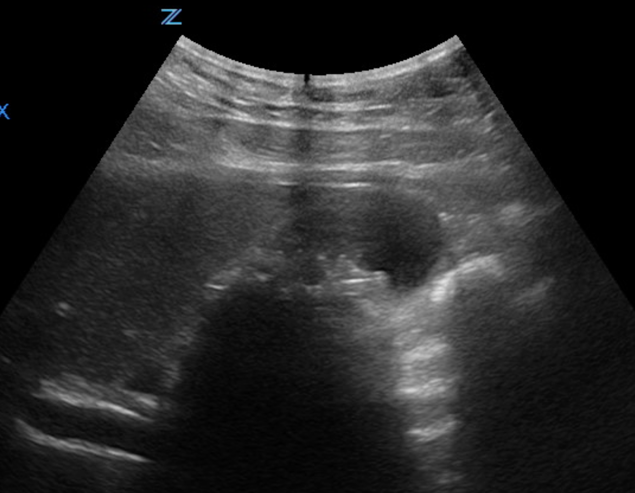 Gallbladder Ultrasound