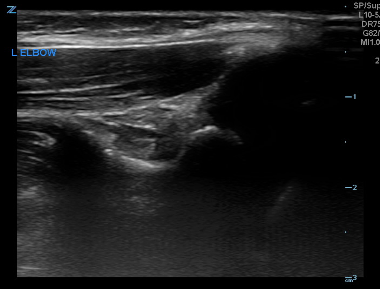 L elbow - sagittal view