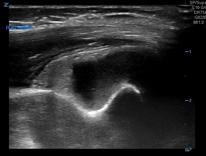 R elbow - sagittal view