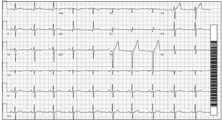 2017 8-13 previous EKG.jpg