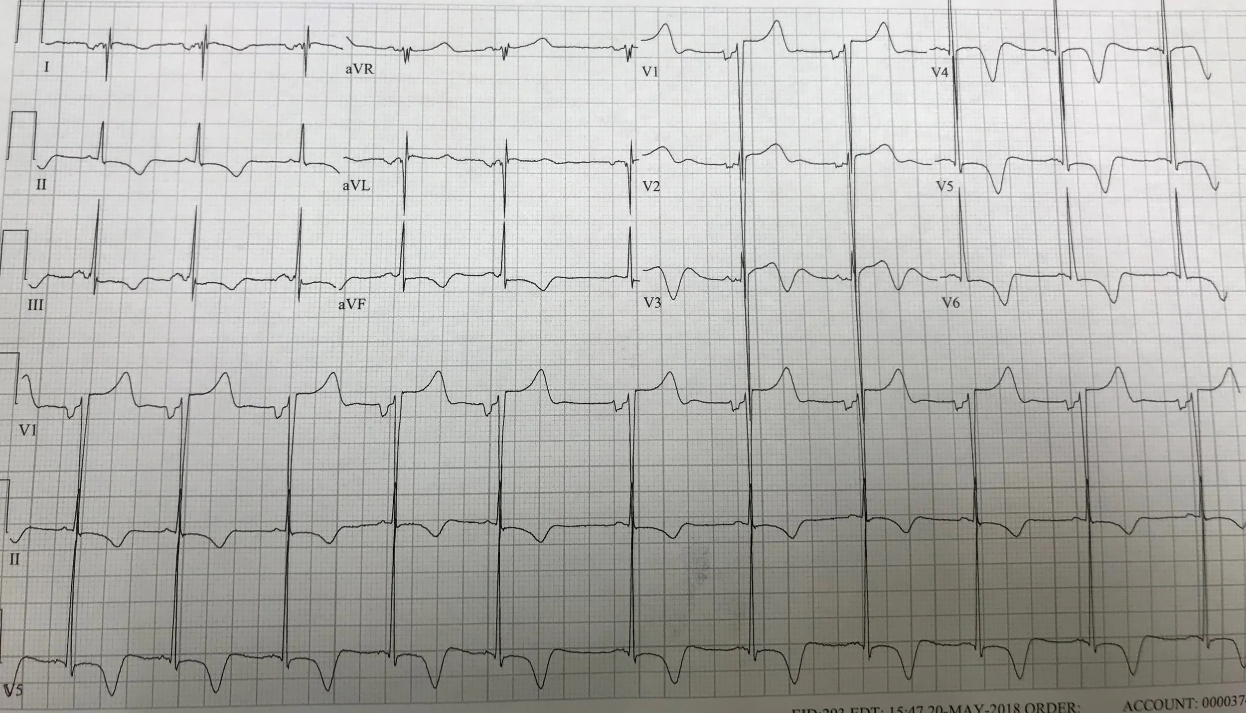 What Is Cerebral T Wave? : The T-wave: physiology, variants and ECG ...