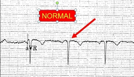 2019 5-5 normal aVR.jpg