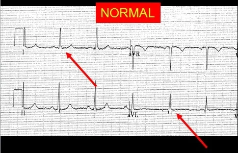 2019 5-5 Normal I and aVL.jpg