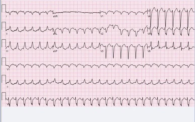 V Tach The Pulse Staten Island University Hospital Emergency