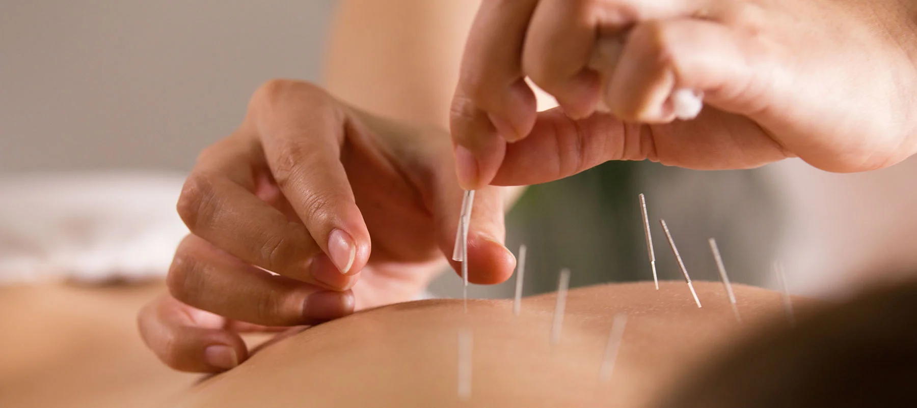 acupuncture-pain-management.jpg