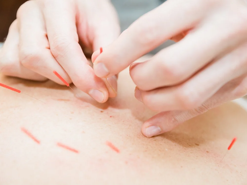 Acupuncture Matt Beigle ACUPUNCTURE & WELLNESS State College, PA