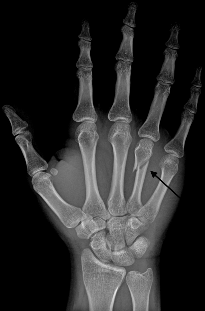 A classic "Boxer's Fracture" at the neck of the 4th metacarpal bone