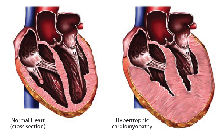 Hypertrophic cardiomyopathy as seen on the right image involves abnormal thickening of the left ventricle (usually the septum) and is the most common cause of SCD