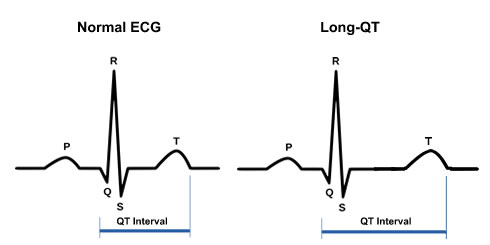 A prolonged QT interval can increase one's risk of a fatal arrythmia and is easily measured on a 12 lead ECG. Above 450 ms in a male and 470 ms in a female is considered abnormal prolongation.