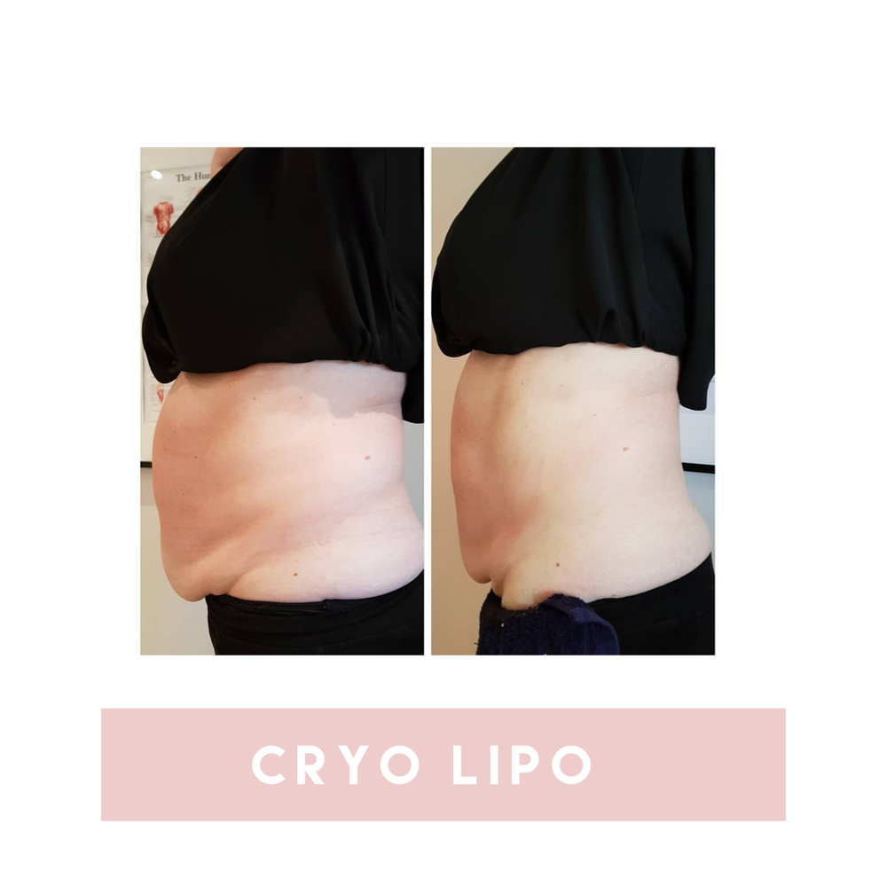 Cryolipolysis cryo lipo body contouring fat freezing 3d lipo