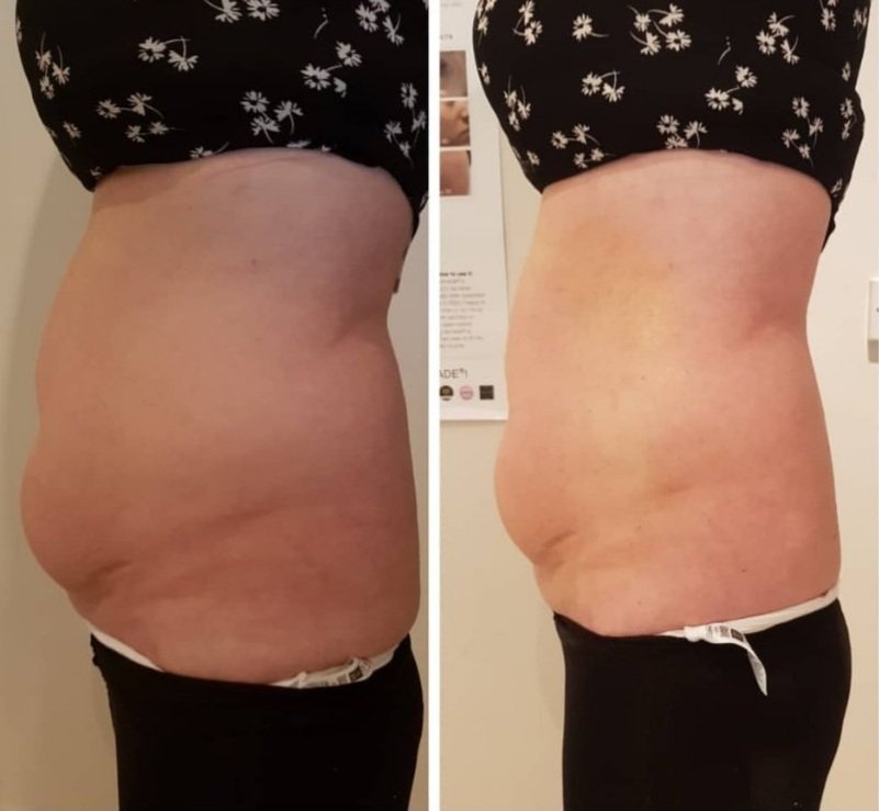 FAT+REMOVAL+RESULTS+6.jpg