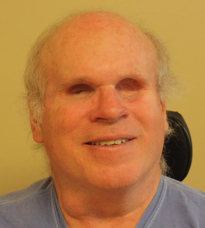 Without Prostheses (Copy)