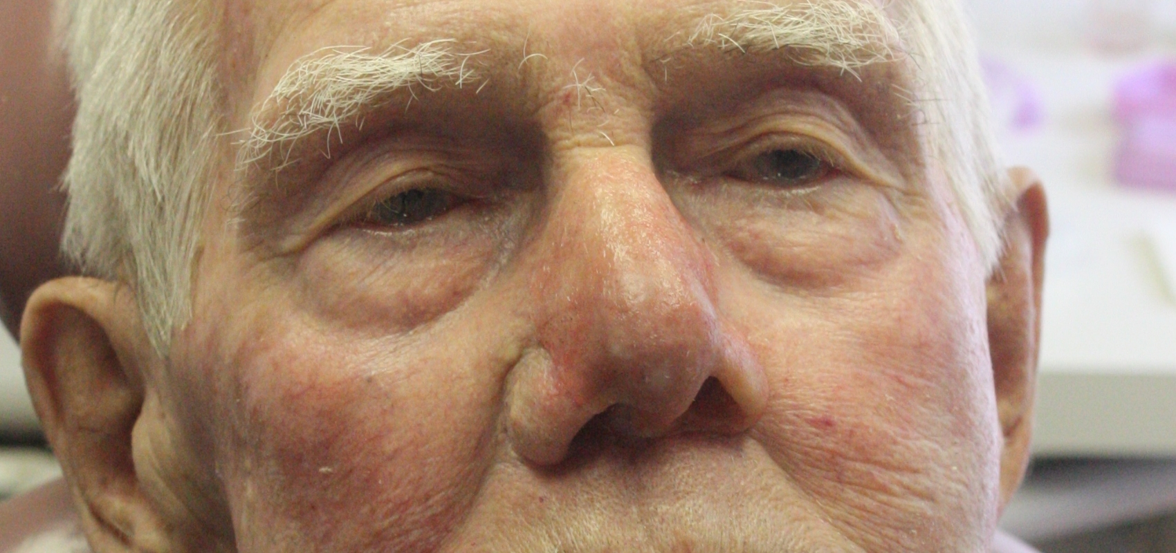 Nasal (Nose) Prosthesis