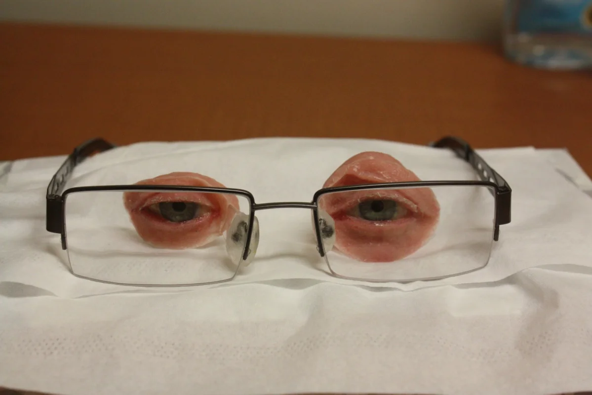 Spectacle-held Bilateral Orbital Prostheses