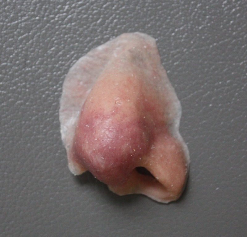 Nasal (Nose) Prosthesis