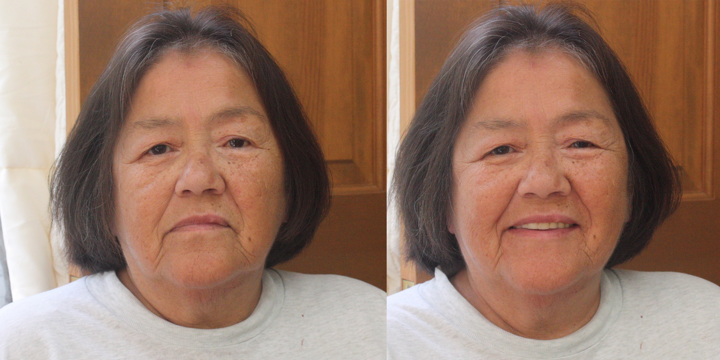 Left Artificial Eye Material: Methyl Methacrylate