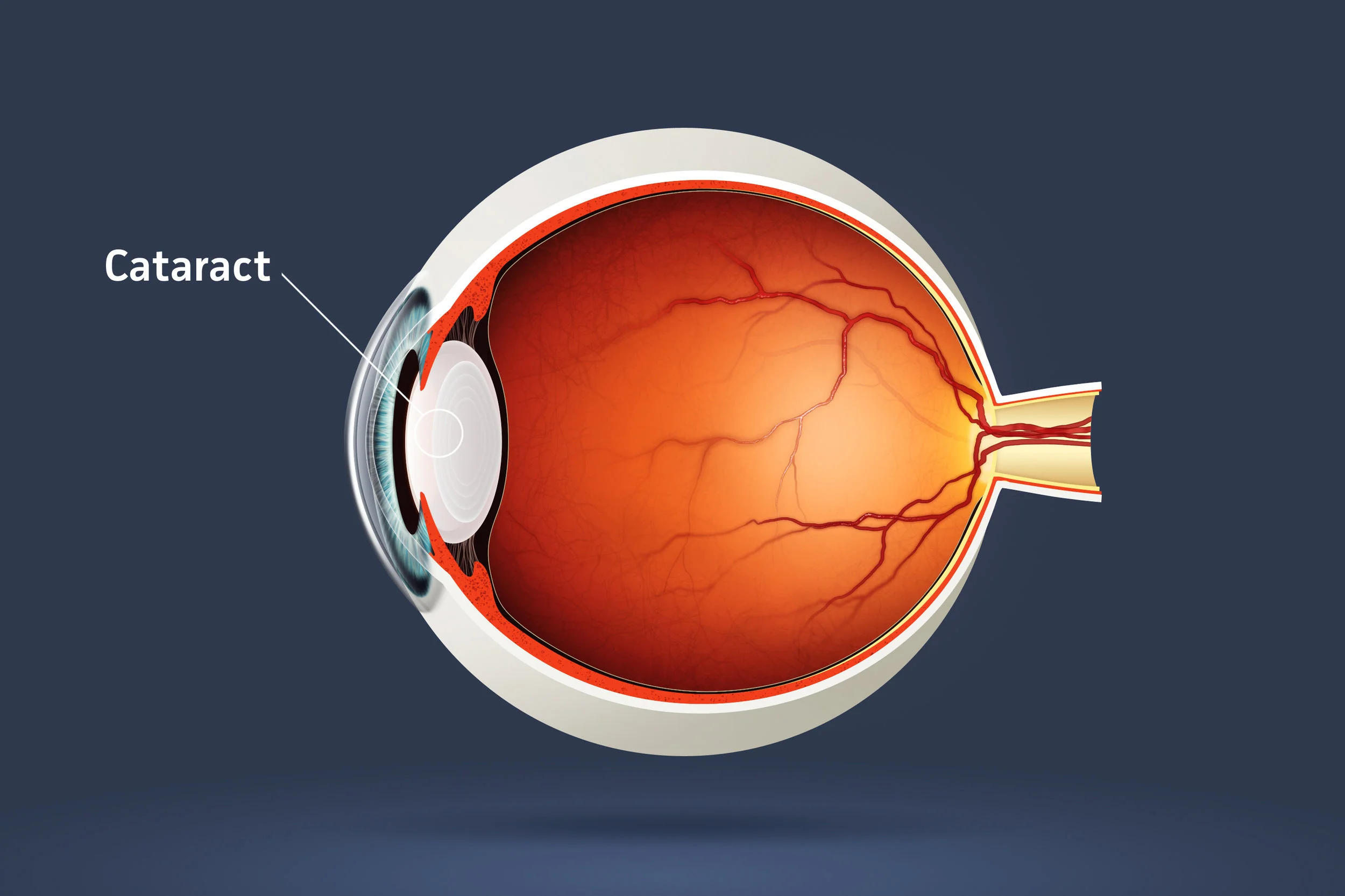 cataract crop.jpg