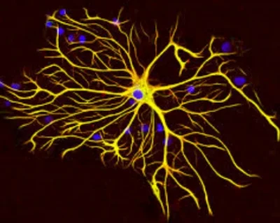 How to Reverse Multiple Sclerosis with Functional Medicine