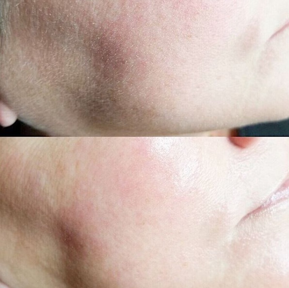 Rosacea_Client_.jpg