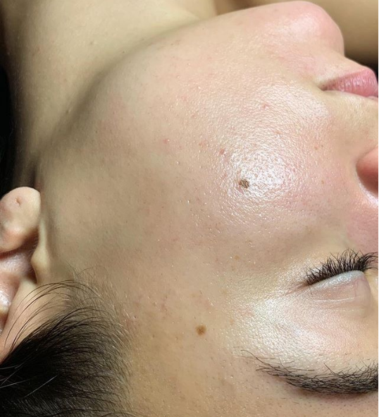 Dermaplaning_Facial_After.png