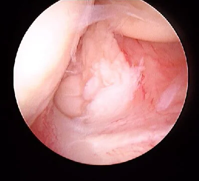 Supine Arthroscopy for Lateral Epicondylitis