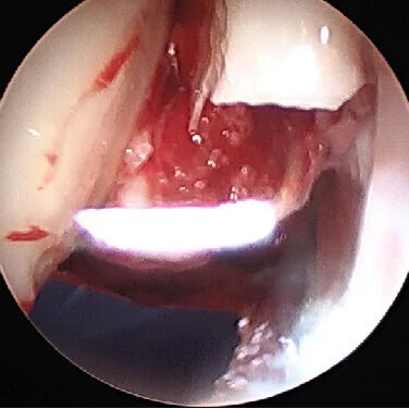 Arthroscopic Radial Head Fracture Fixation