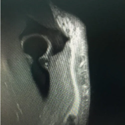 Chronic Triceps Tendon Rupture Treated With Achilles Tendon Allograft
